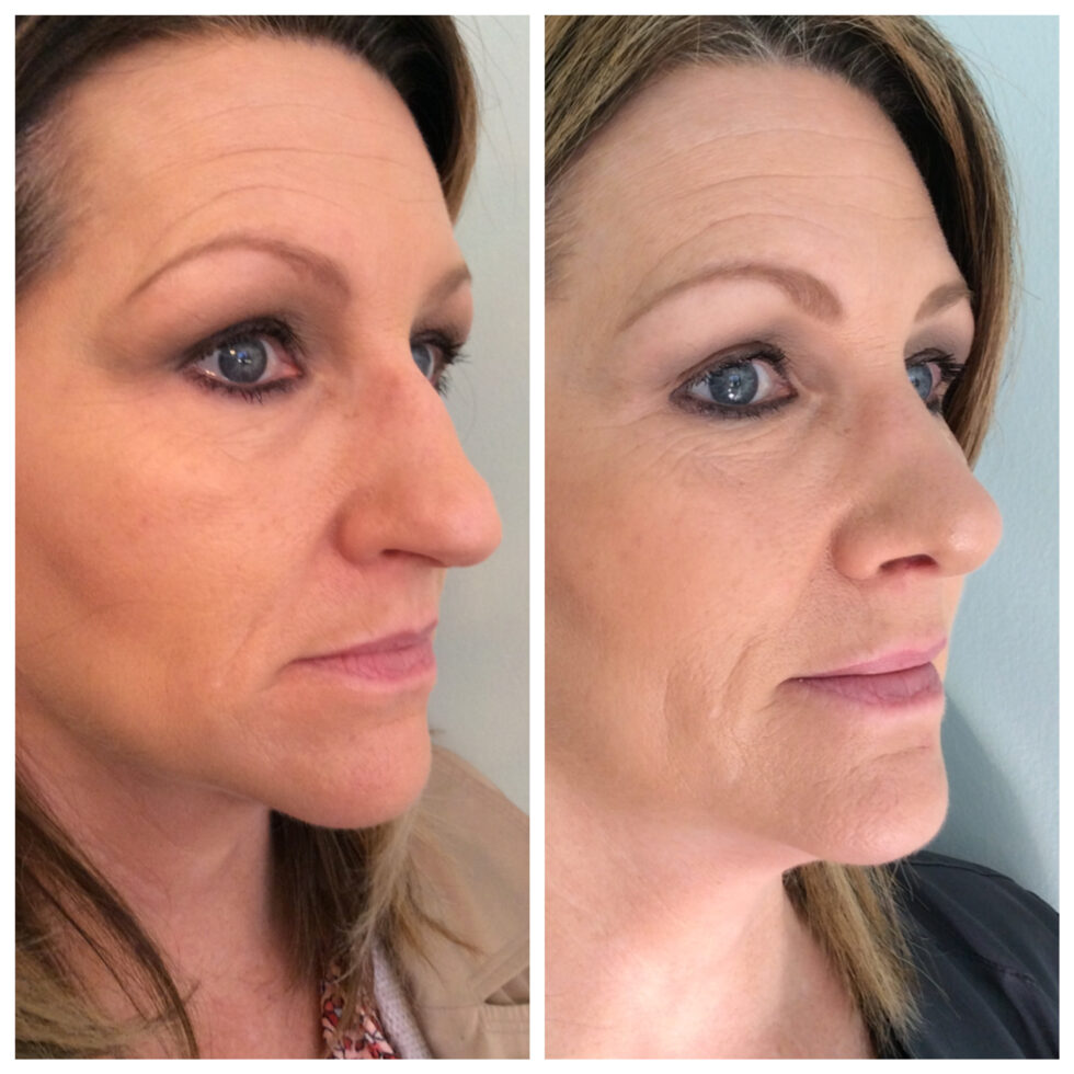 Rhinoplasty Ozark Facial Plastic Surgery And Aesthetics